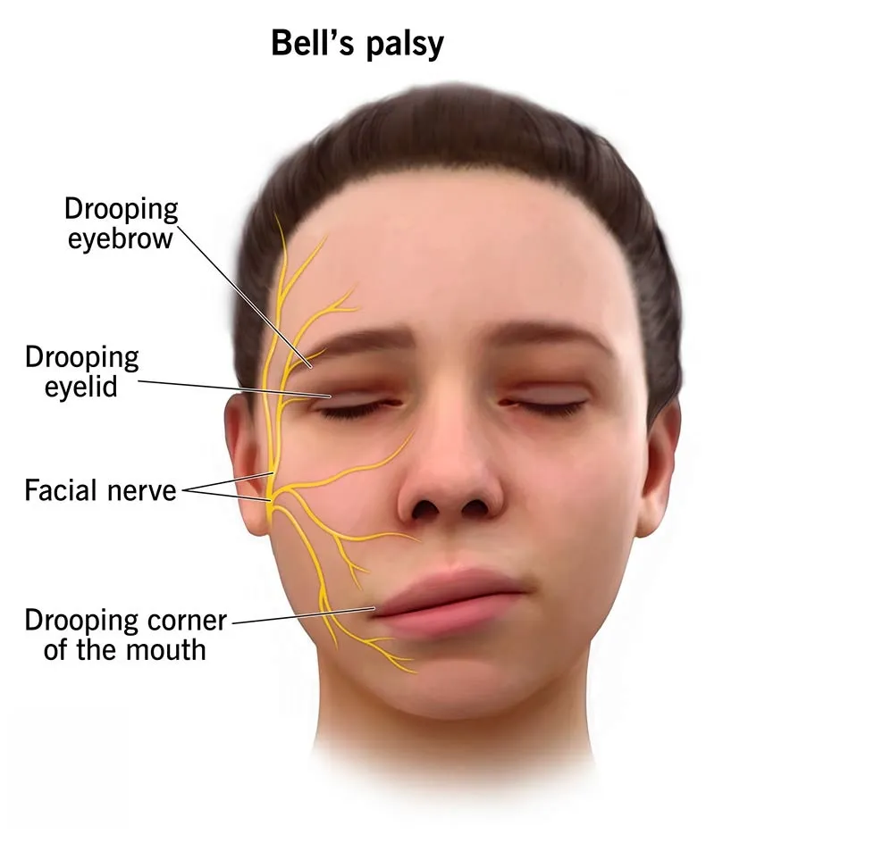 What is Facial Paralysis | Dr PR Bhuyan