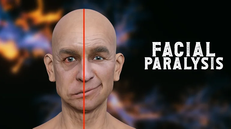 Facial Paralysis Treatment