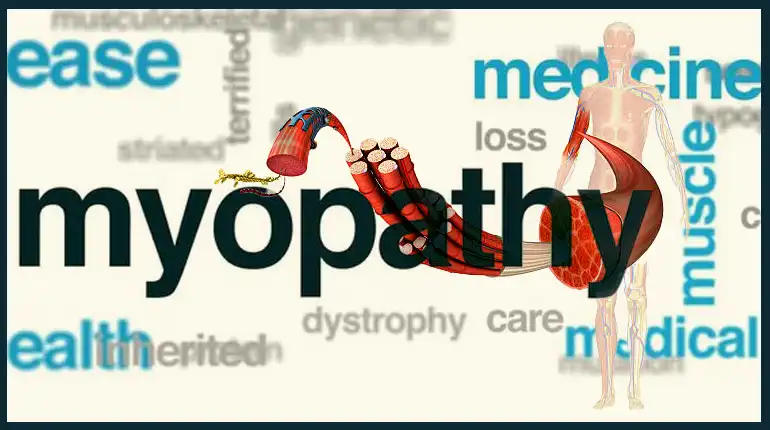 Myopathy Treatment