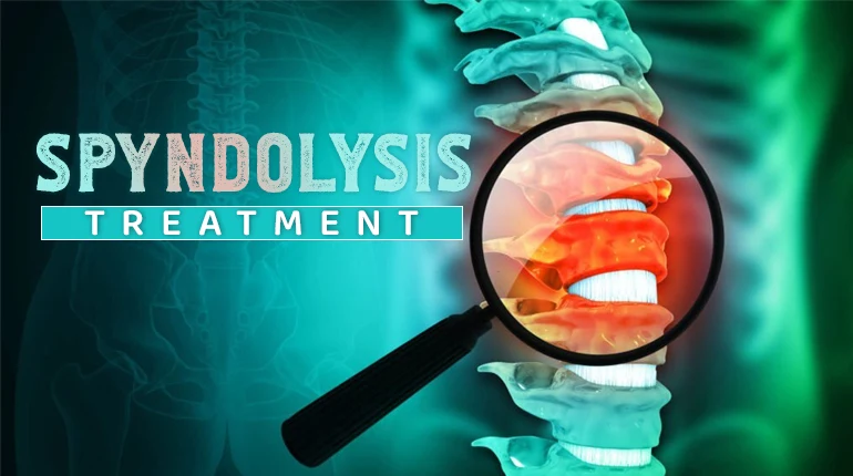 Spondylosis Treatment
